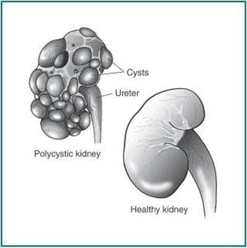Polycystic Kidney Graphic