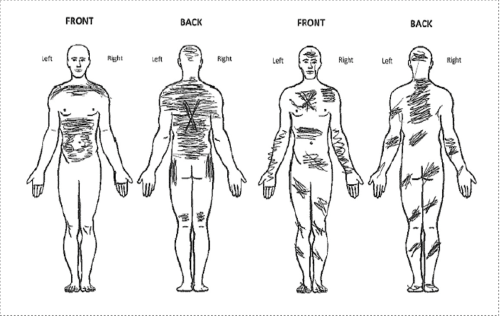 Four outlines of a person showing where itchiness may occur throughout the body