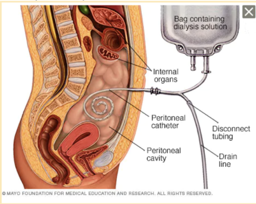 Diagram showing how peritoneal dialysis works.