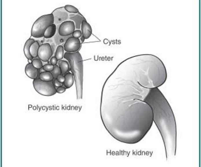 Polycystic Kidney Graphic