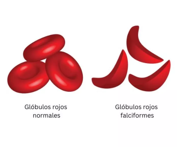 Normal cell compared to sickle cell