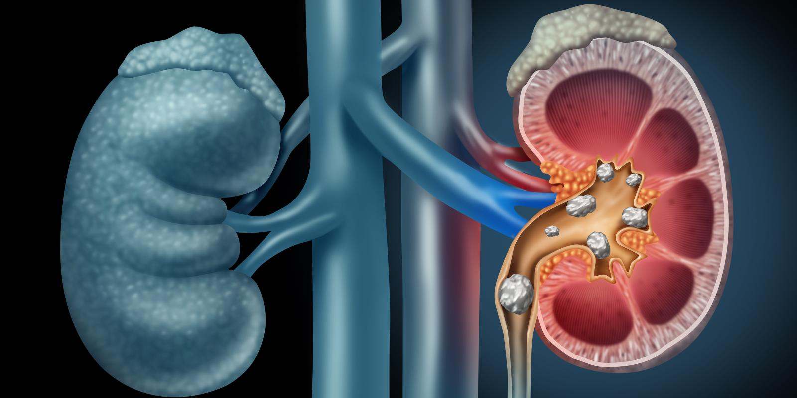 Illustration of kidney stones