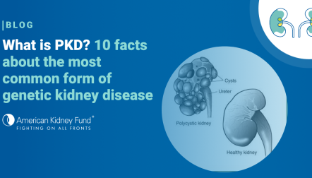 Polycystic kidney (PKD) compared to normal kidney with blue text overlay "What is PKD? 10 facts about the most common form for genetic kidney disease"