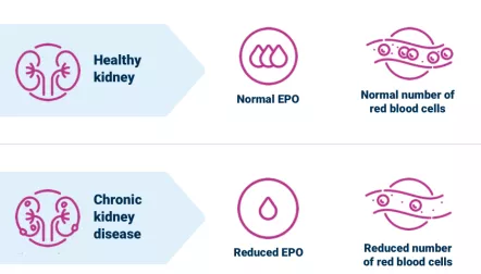 Chart of a healthy kidney versus a ckd kidney
